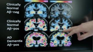 VOATEK - Ep27_Inside the Brain (Alzheimer's disease) (video)